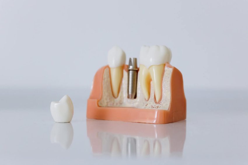 Co to są implanty zębowe